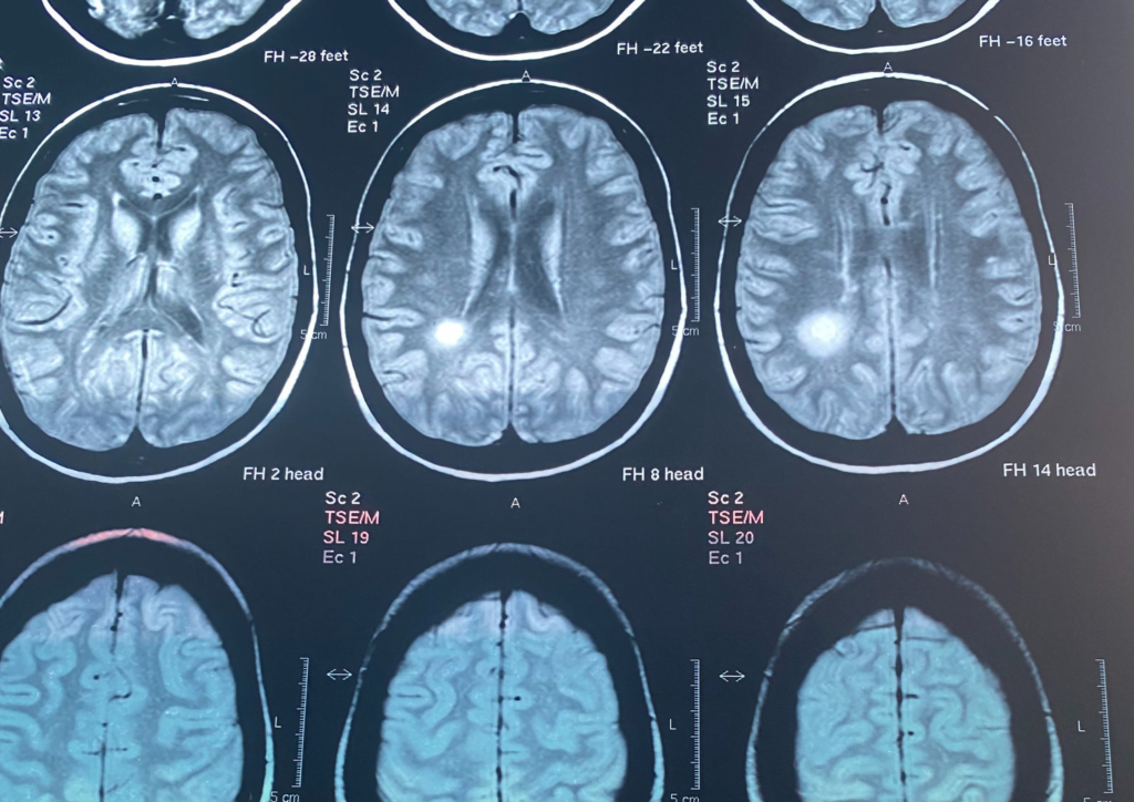 Lucie MRI with big MS lesion 2002